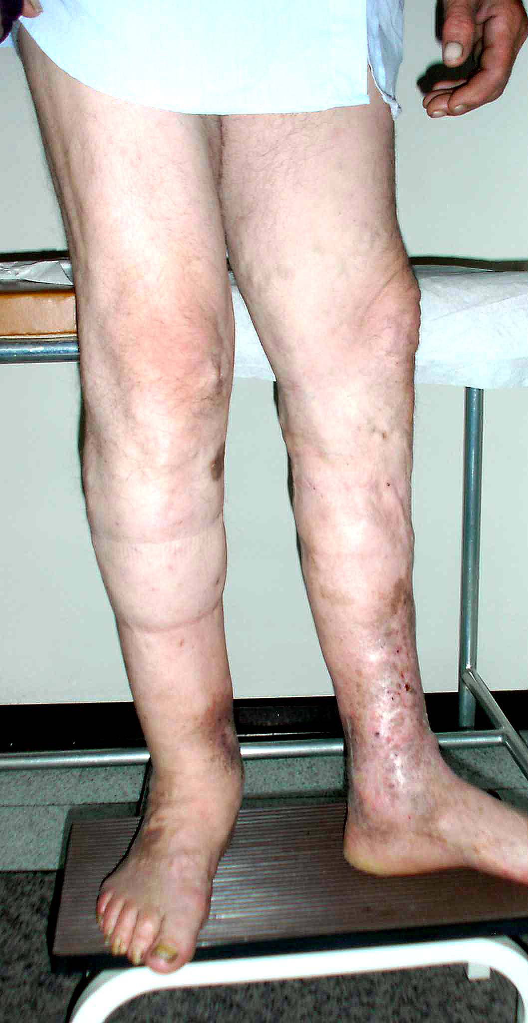 sindrome post-trombotica flebo-linfedema della gamba destra