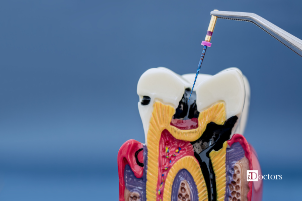 Illustrazione della cura canalare con strumento endodontico inserito all’interno del dente.