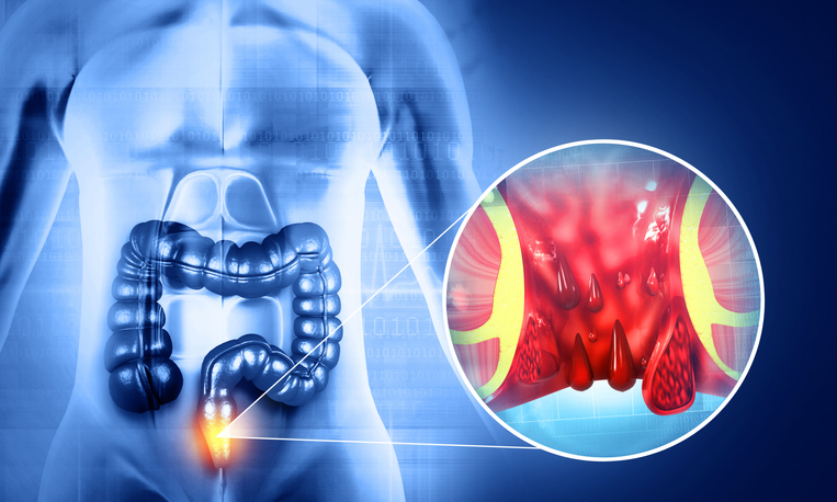 Illustrazione 1 - Chirurgia Proctologica e Proctologia