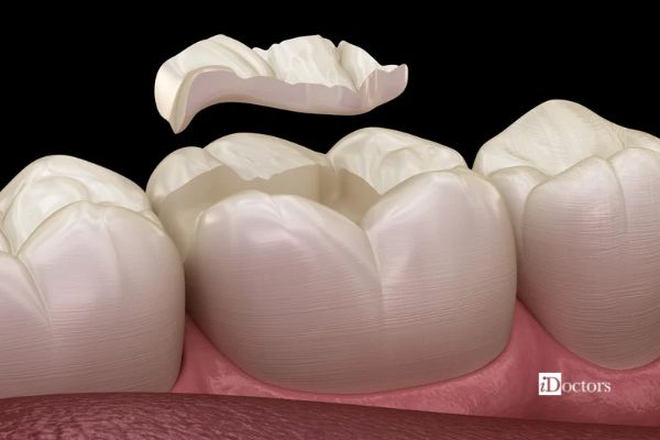 Illustrazione di un intarsio estetico da inserire nella cavità di un molare per ricostruirne la superficie masticatoria.