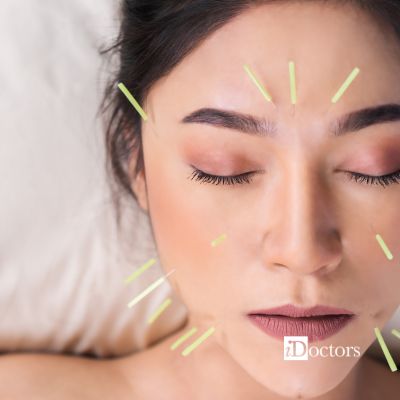 Donna distesa durante una seduta di agopuntura, con aghi posizionati su fronte, guance e mento