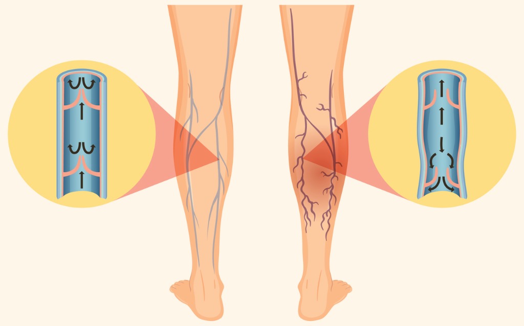 Illustrazione 1 - Chirurgia Vascolare