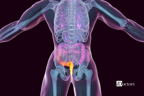Illustrazione del colon e del retto, sedi di possibili cause del sanguinamento rettale.