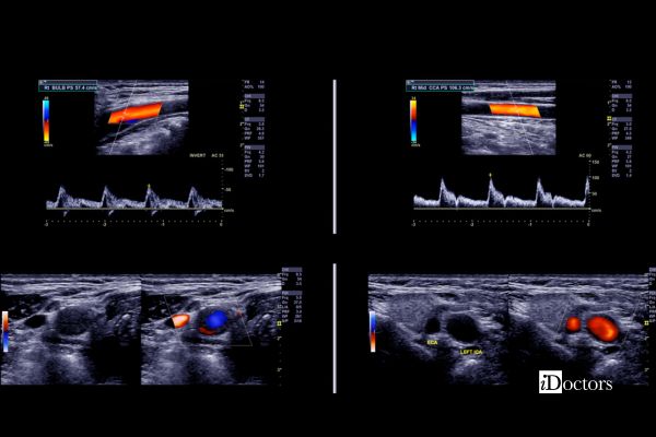 Immagini ecocolordoppler di vasi sanguigni con flusso a colori e tracciati Doppler.