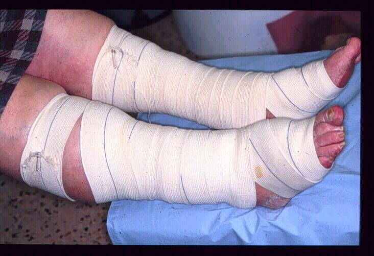 inizialmente doloroso per cui sarà bene riconfezionarlo ab inizio se il paziente riferisce dolore a riposo o col movimento(Fig. 28). Se, invece, il dolore compare successivamente e spesso associato a cianosi ed edema di avampiede, è sufficiente il semplice esercizio fisico od il riconfezionamento dello stesso. E’ molto importante, comunque, saper distinguere la 