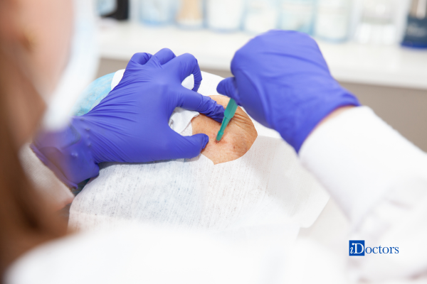 Asportazione ambulatoriale di una lesione cutanea eseguita da un medico.