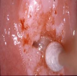 papilloma virus e colposcopia cancer ovarian endometriosis