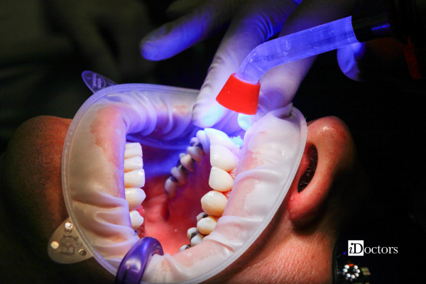 Dentista durante l'esecuzione di un'otturazione dentale su un paziente.
