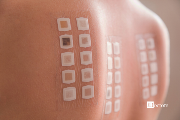 Cerotti del Patch test applicati sulla schiena per valutare eventuali reazioni allergiche da contatto.
