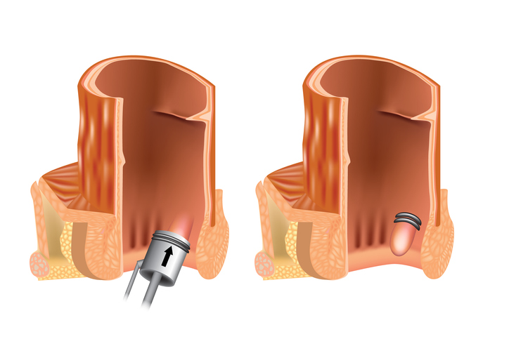 Illustrazione 1 - Chirurgia Proctologica e Proctologia