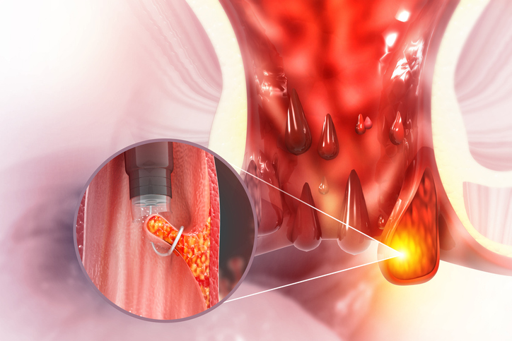 Illustrazione 1 - Chirurgia Proctologica e Proctologia