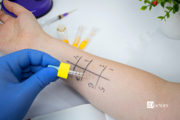 Esecuzione di un Prick test sull'avambraccio per valutare la sensibilizzazione a specifici allergeni.