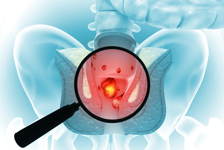 Illustrazione 1 - Chirurgia Proctologica e Proctologia