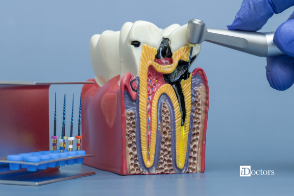 Illustrazione della cura canalare di un dente posteriore con strumenti endodontici.