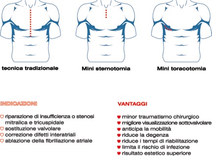 cardiochirurgia mini cardiochirurgia mini