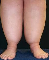 Lipedema nelle donne