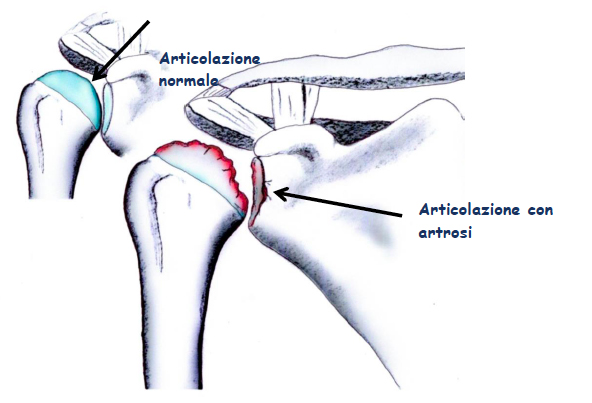 articolazine normale e con artrosi