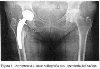 Artoprotesi d'anca radiografia