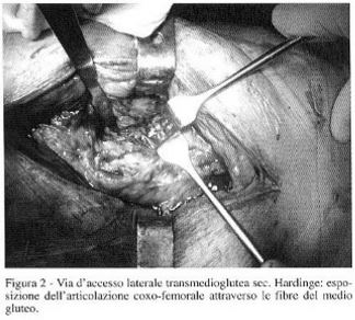 Artoprotesi d'anca via d'accesso laterale