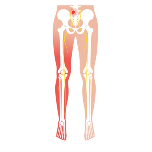 Lombosciatalgia