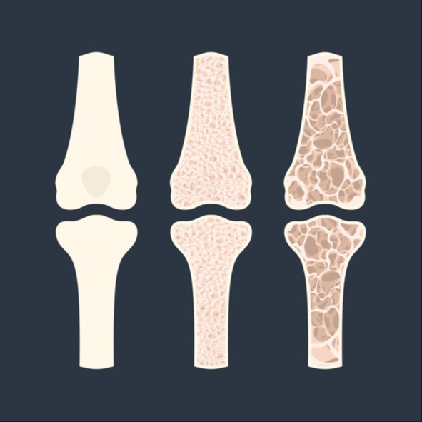 Osteoporosi