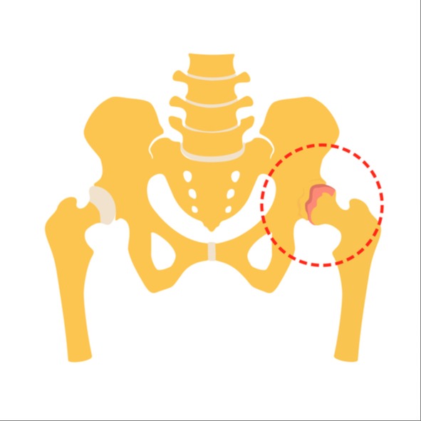 coxartrosi (o artrosi anca)
