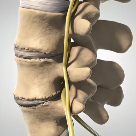 Spondilolistesi