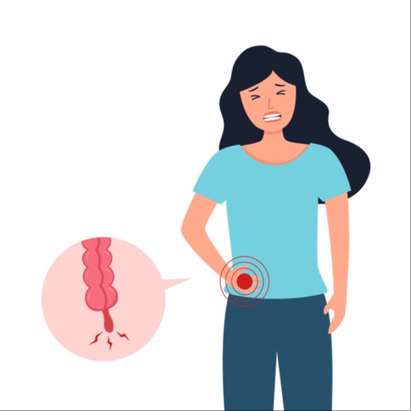 Appendicite cause, sintomi, cosa è