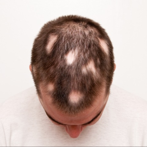 Alopecia