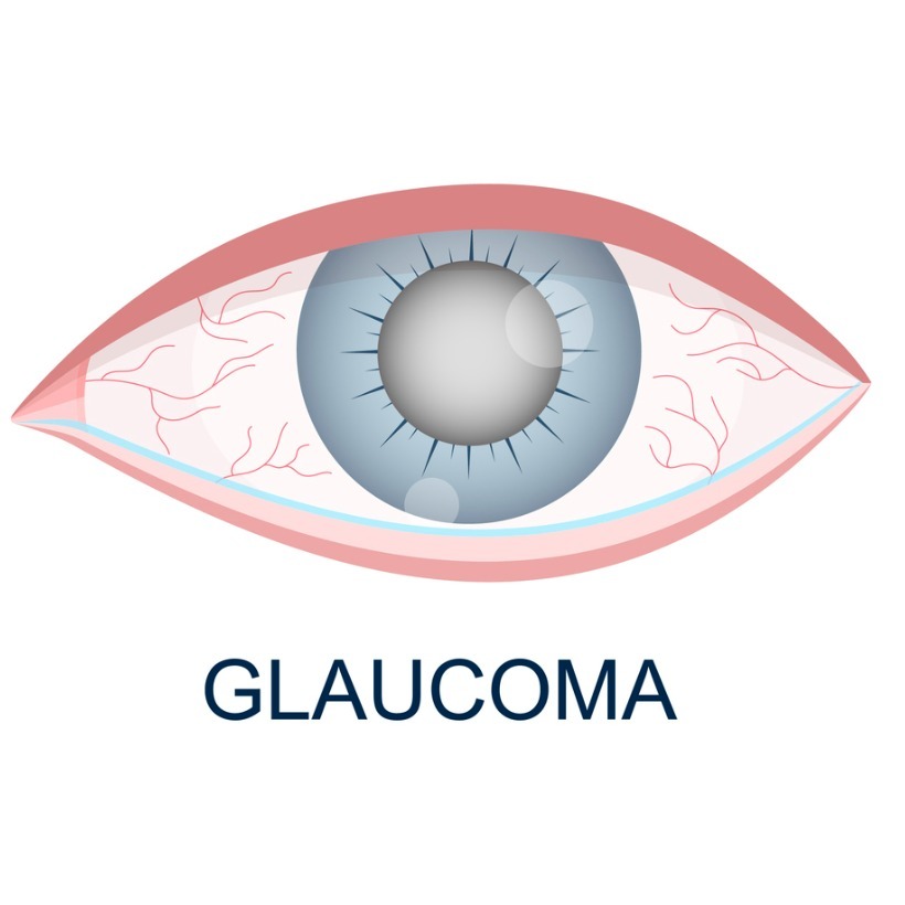 Glaucoma