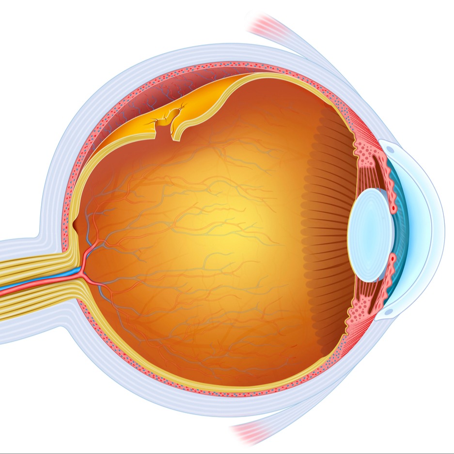 Distacco della retina