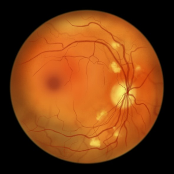 Retinopatia diabetica