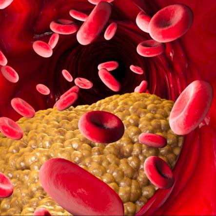 dislipidemia (alterazione lipidi nel sangue)