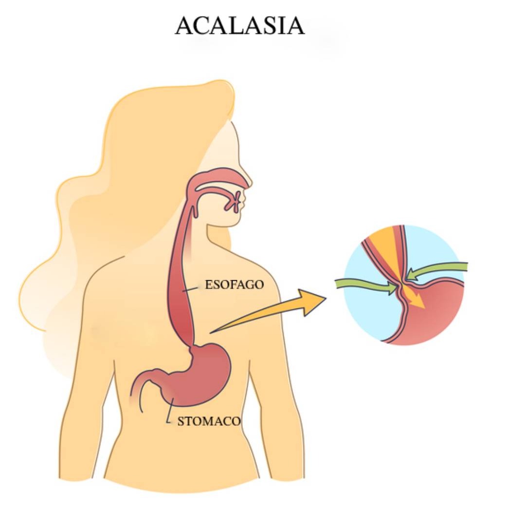 Acalasia