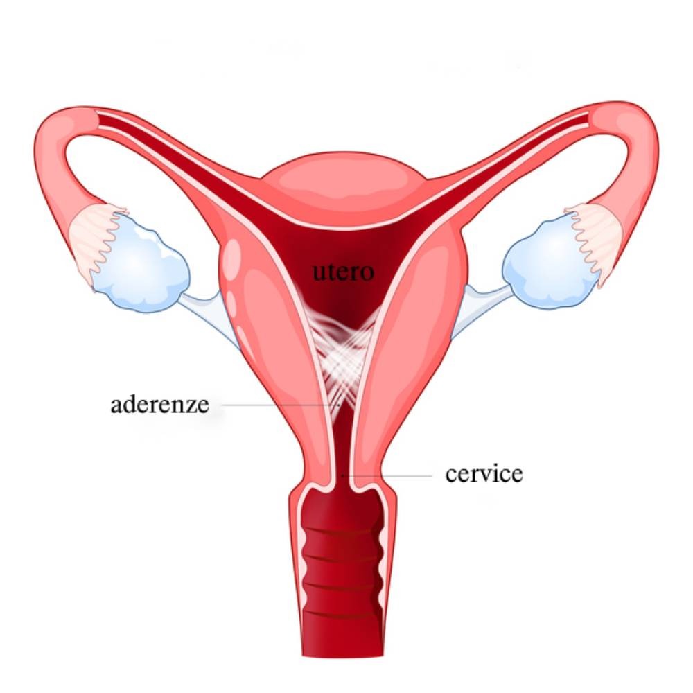 Sinechie uterine