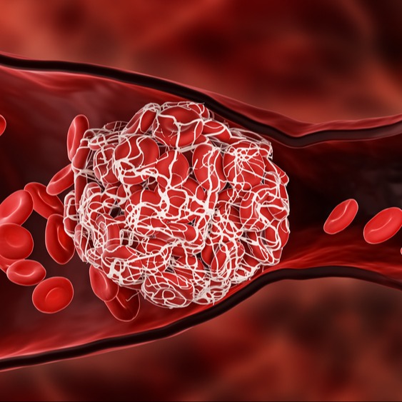 Sindrome da anticorpi antifosfolipidi