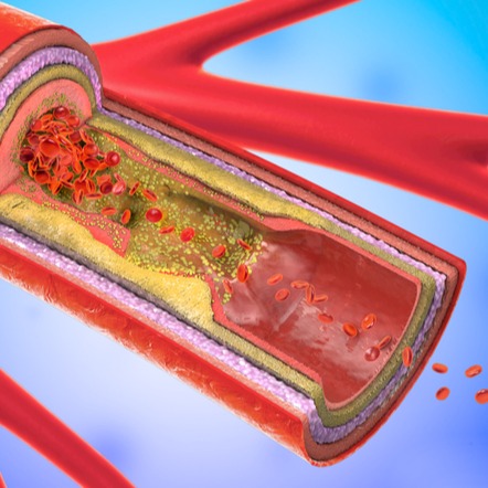 Stenosi carotidea