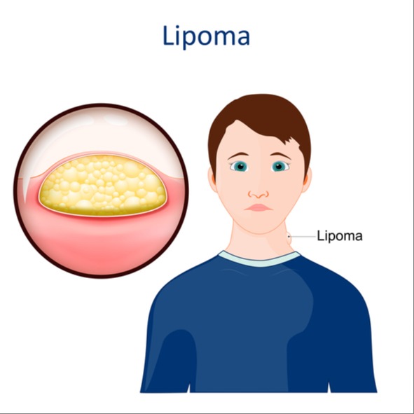 Lipomi (fibrolipomi)