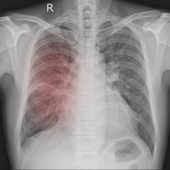 noduli polmonari