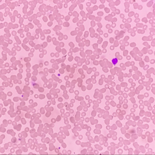 piastrinopenie (trombocitopenia)