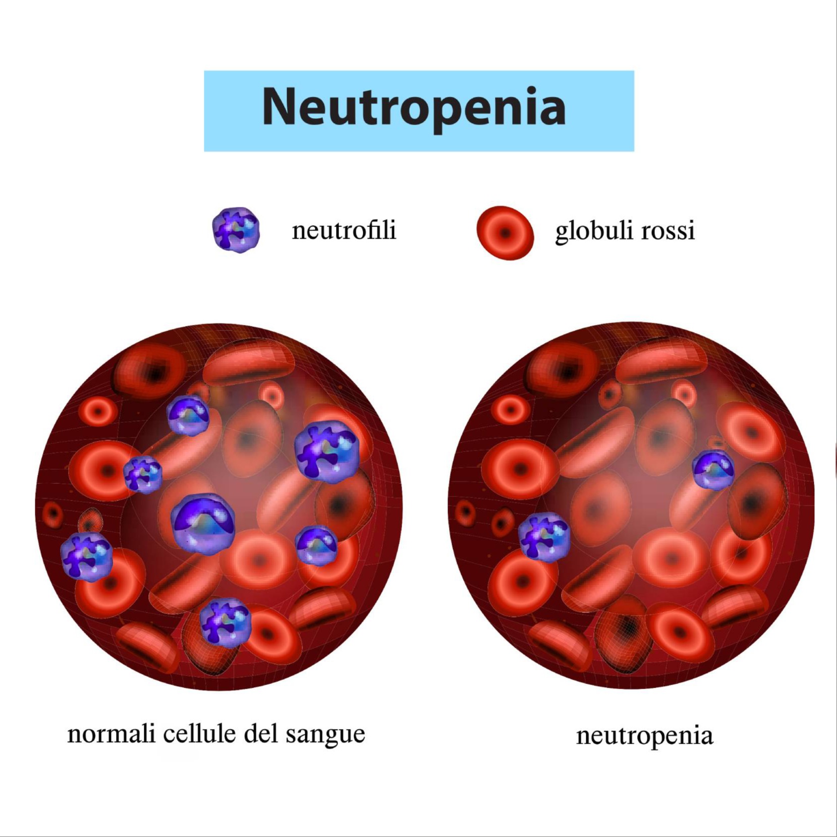 Neutropenia febbrile