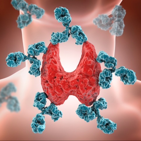 Tiroidite di Hashimoto (tiroidite cronica autoimmune)