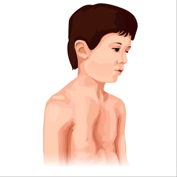 Pectus excavatum