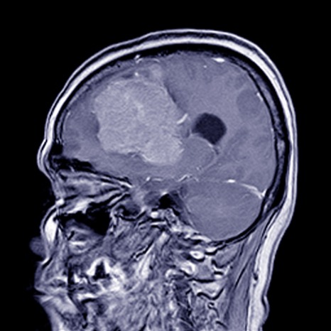 Meningioma