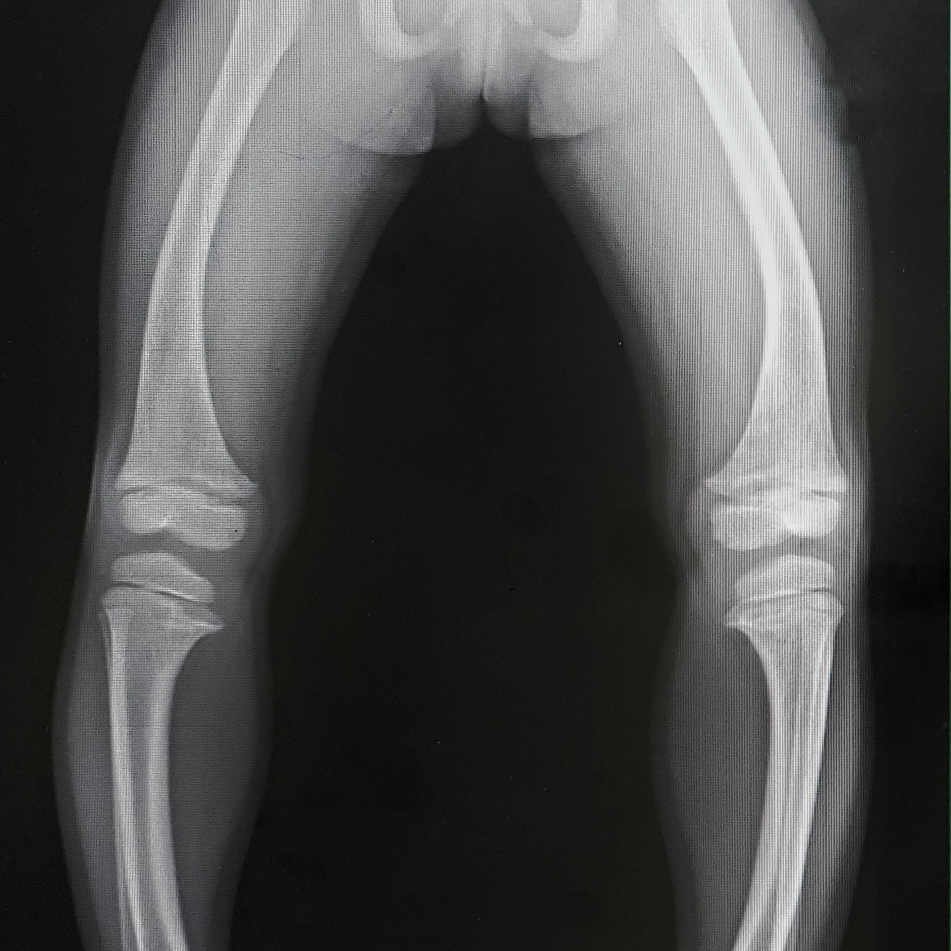 Osteomalacia