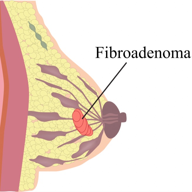 Fibroadenoma