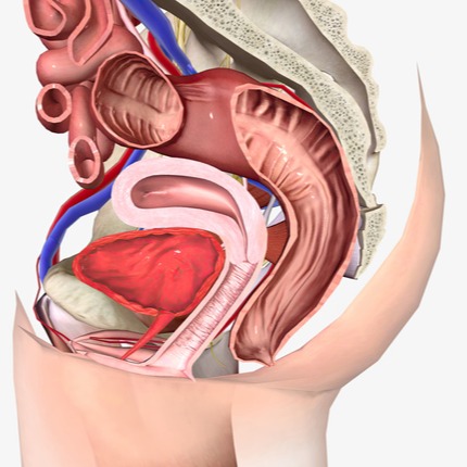 Cistocele