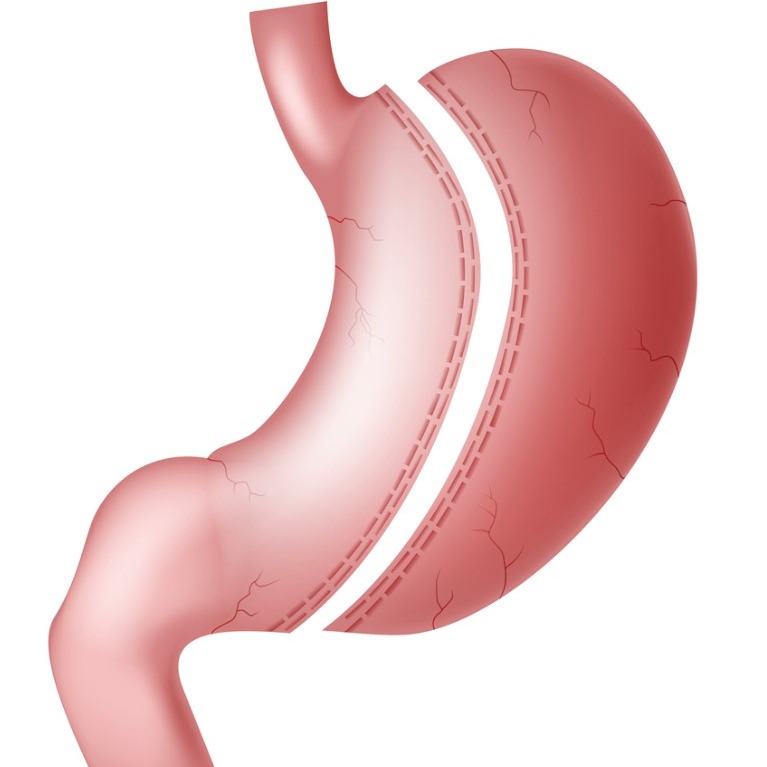 Sleeve gastrectomy