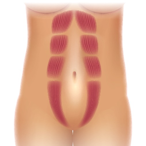 Diastasis recti repair with onlay mesh