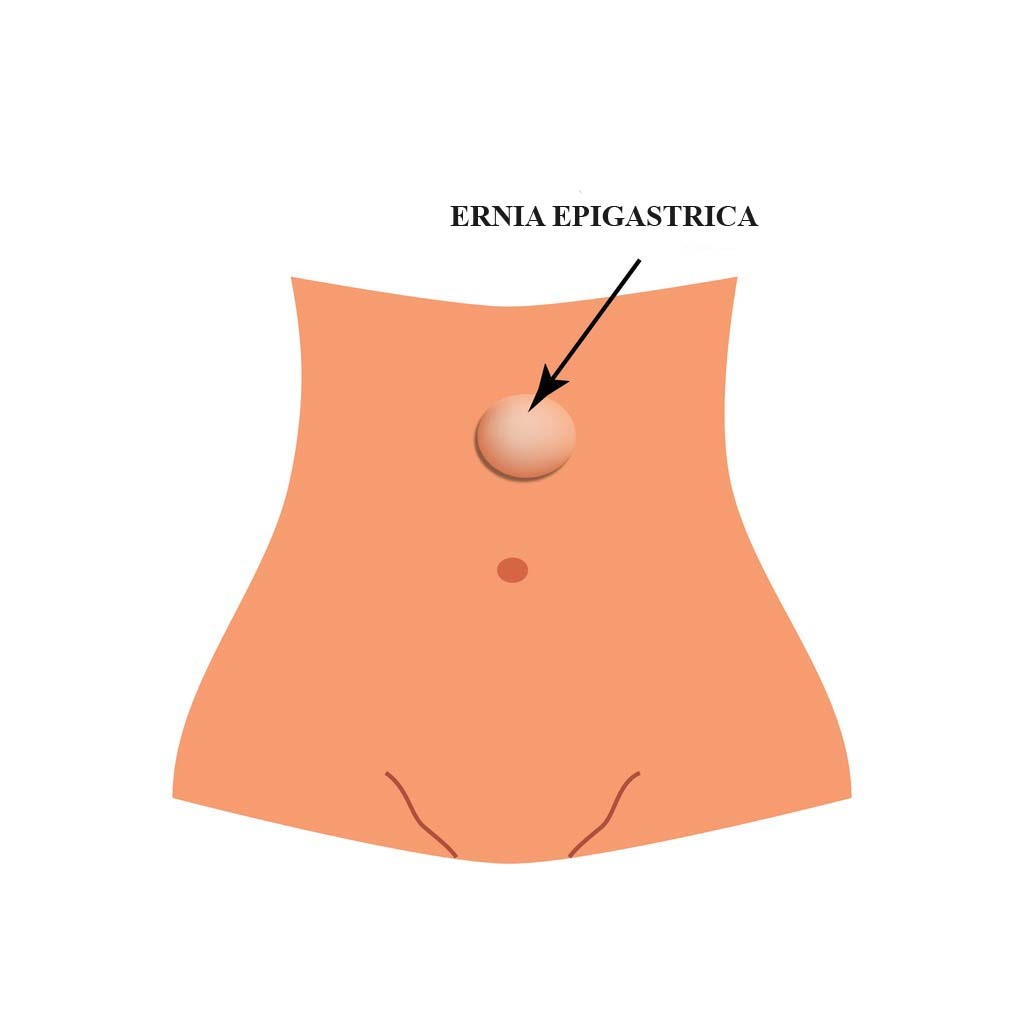 Ernia epigastrica